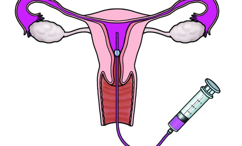 هیستروسالپنگوگرافی چیست؟